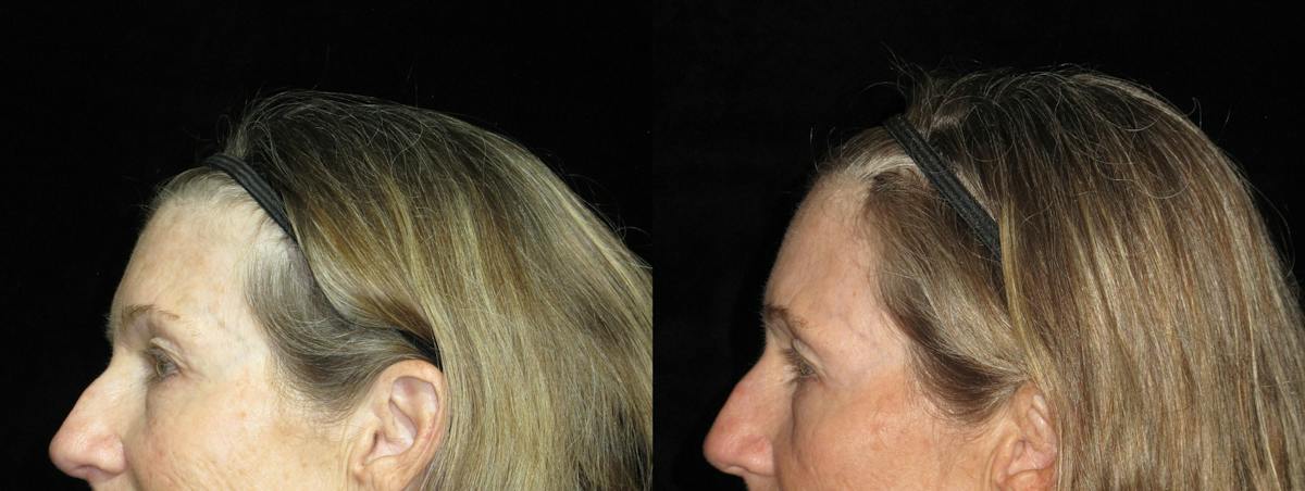 Eyelid Surgery Before & After Gallery - Patient 334558 - Image 3