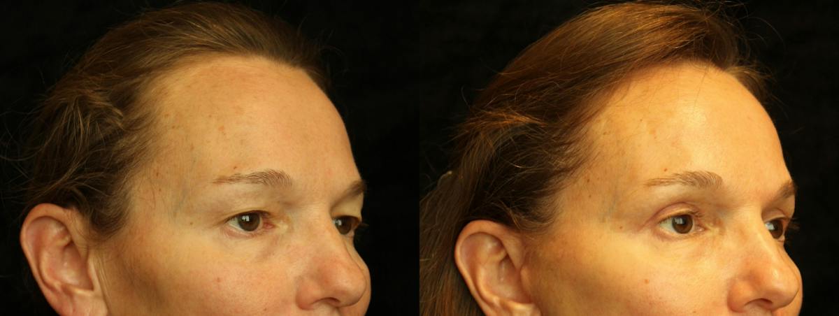 Eyelid Surgery Before & After Gallery - Patient 271117 - Image 2