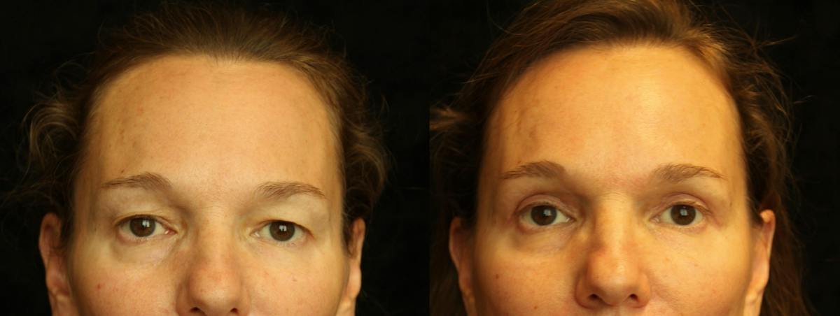 Eyelid Surgery Before & After Gallery - Patient 271117 - Image 1