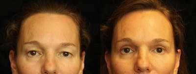 Eyelid Surgery Before & After Gallery - Patient 271117 - Image 1
