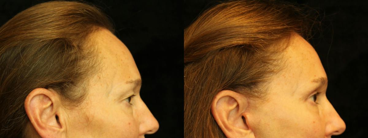 Eyelid Surgery Before & After Gallery - Patient 271117 - Image 3