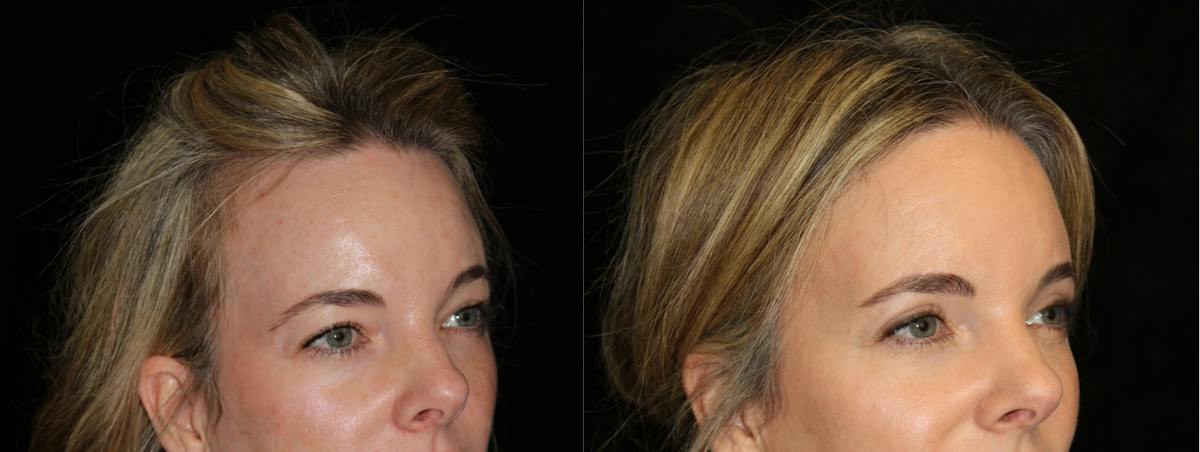 Eyelid Surgery Before & After Gallery - Patient 106323 - Image 2