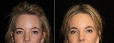 Eyelid Surgery Before & After Gallery - Patient 106323 - Image 1