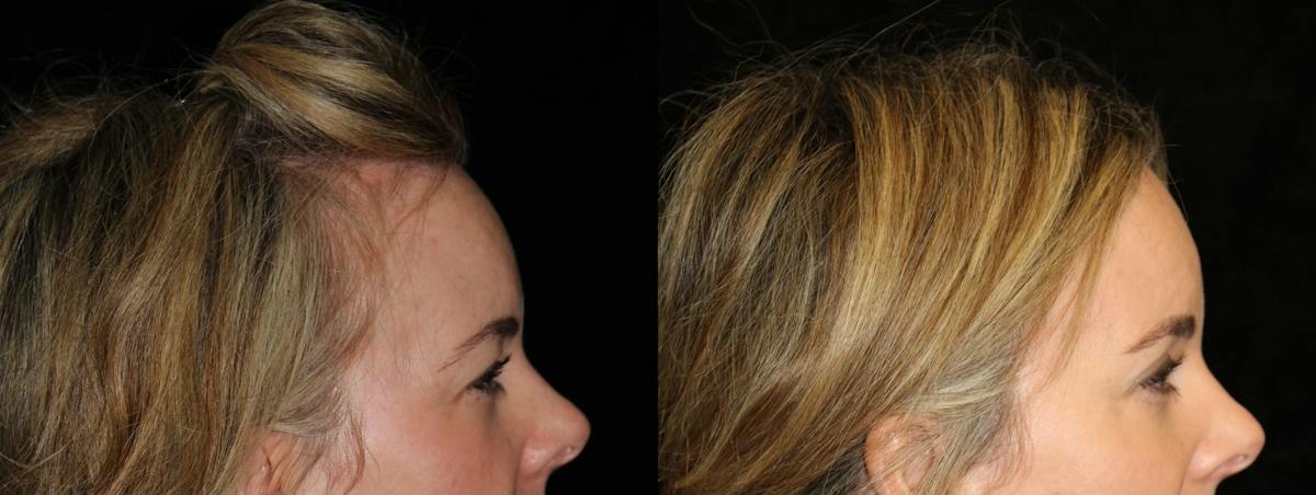 Eyelid Surgery Before & After Gallery - Patient 106323 - Image 3
