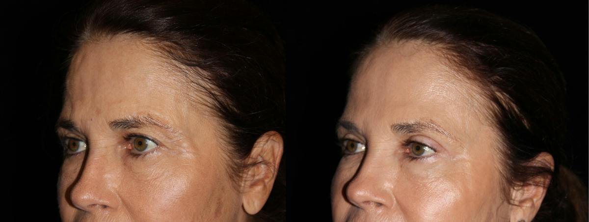 Eyelid Surgery Before & After Gallery - Patient 216945 - Image 2
