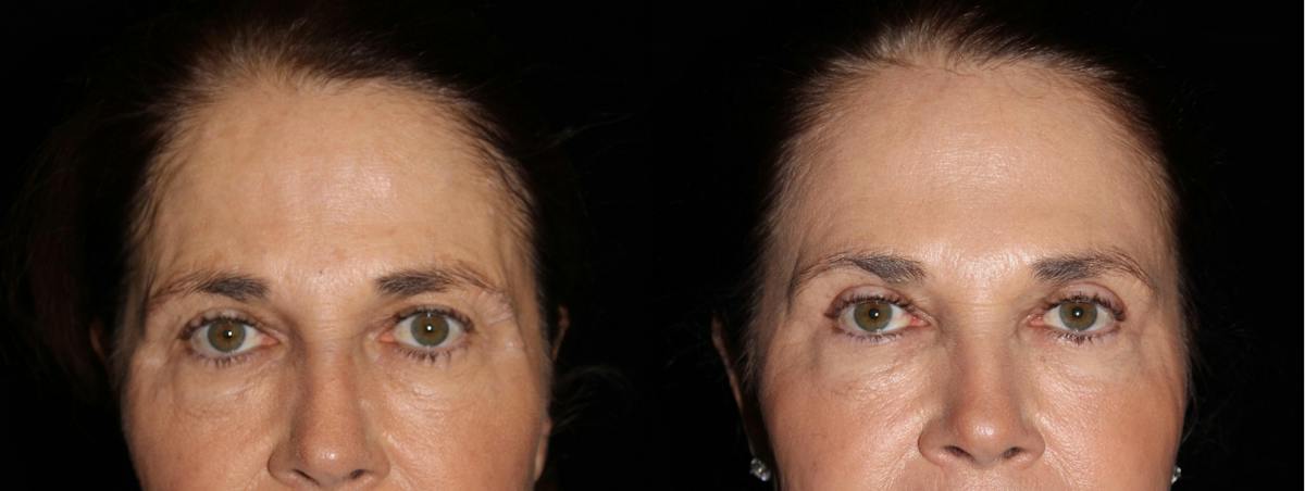 Eyelid Surgery Before & After Gallery - Patient 216945 - Image 1