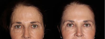 Eyelid Surgery Before & After Gallery - Patient 216945 - Image 1
