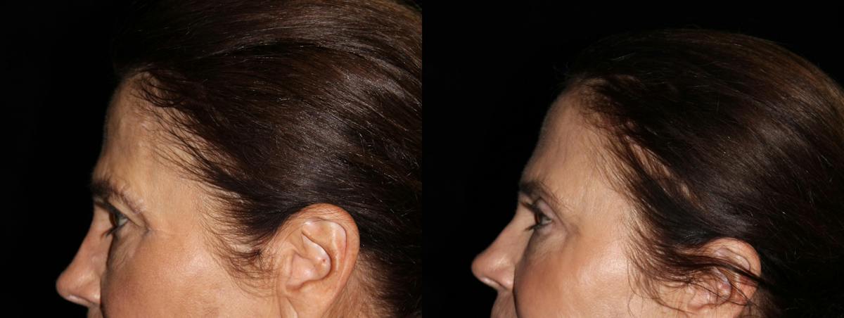 Eyelid Surgery Before & After Gallery - Patient 216945 - Image 3