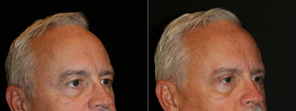 Eyelid Surgery Before & After Gallery - Patient 148374 - Image 2