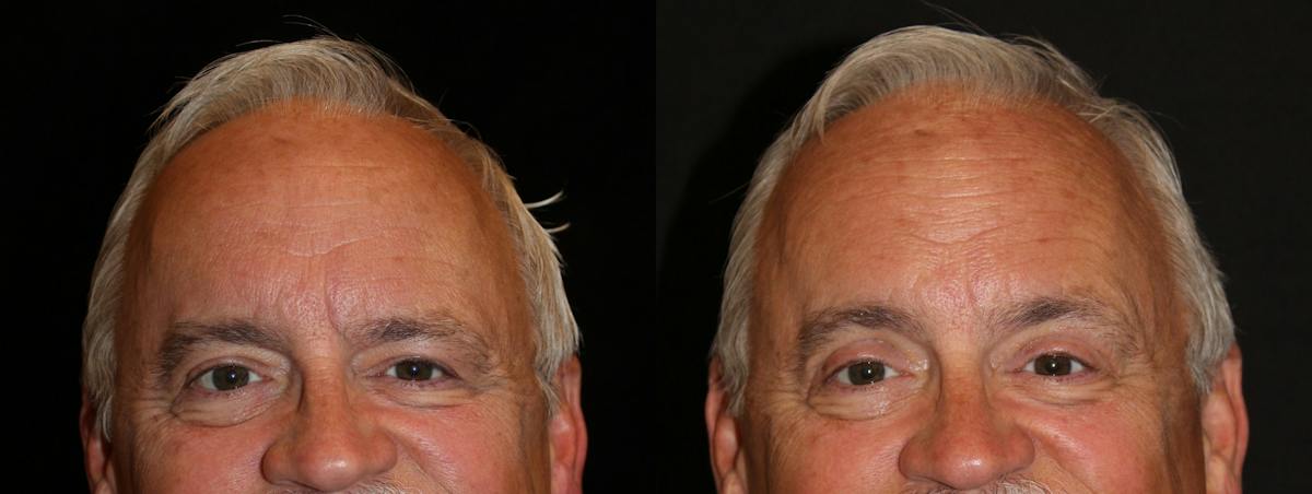 Eyelid Surgery Before & After Gallery - Patient 148374 - Image 1