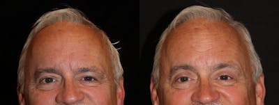 Eyelid Surgery Before & After Gallery - Patient 148374 - Image 1
