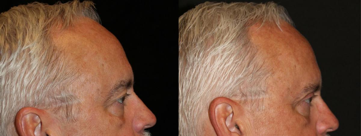 Eyelid Surgery Before & After Gallery - Patient 148374 - Image 3