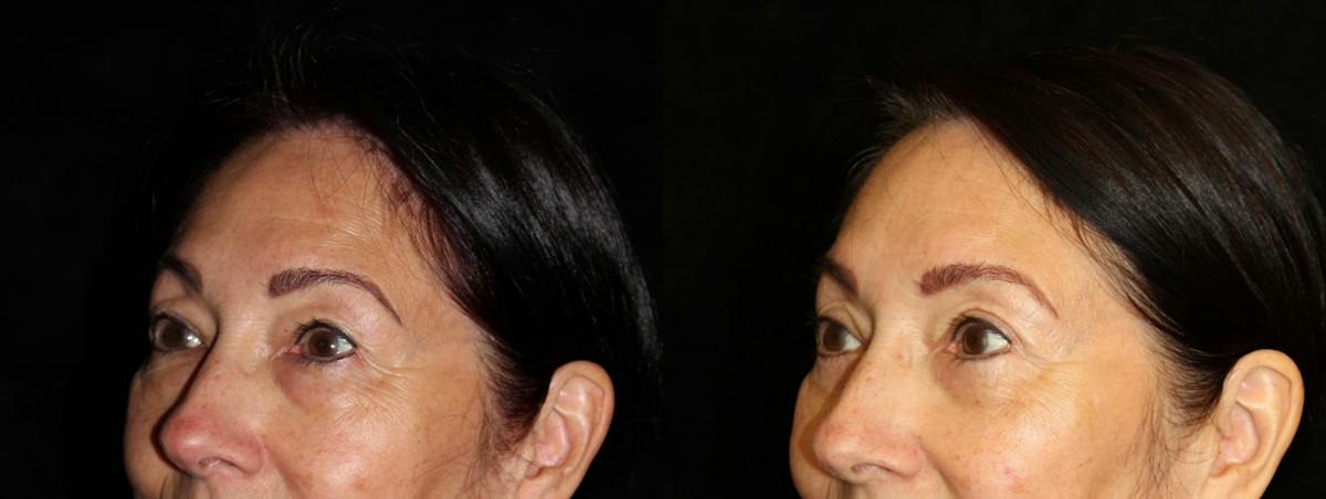 Eyelid Surgery Before & After Gallery - Patient 447053 - Image 2