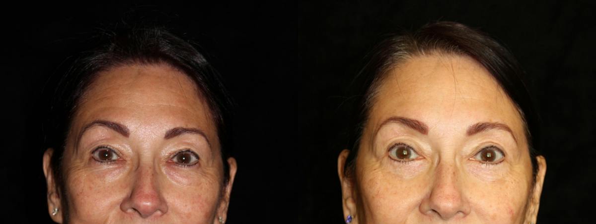 Eyelid Surgery Before & After Gallery - Patient 447053 - Image 1
