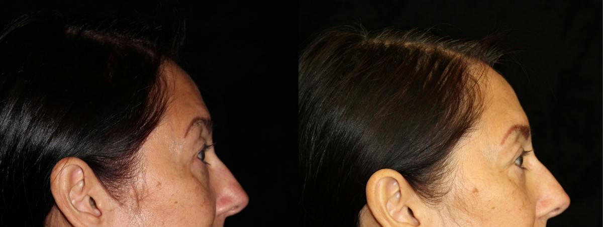 Eyelid Surgery Before & After Gallery - Patient 447053 - Image 3
