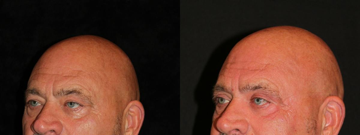 Eyelid Surgery Before & After Gallery - Patient 341994 - Image 2