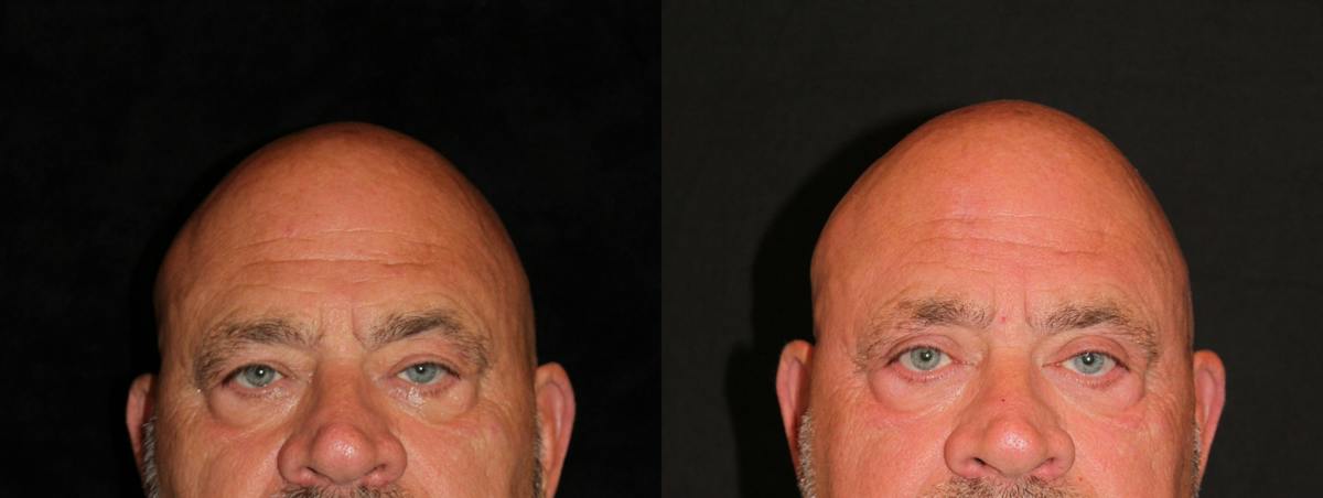 Eyelid Surgery Before & After Gallery - Patient 341994 - Image 1