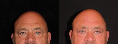 Eyelid Surgery Before & After Gallery - Patient 341994 - Image 1