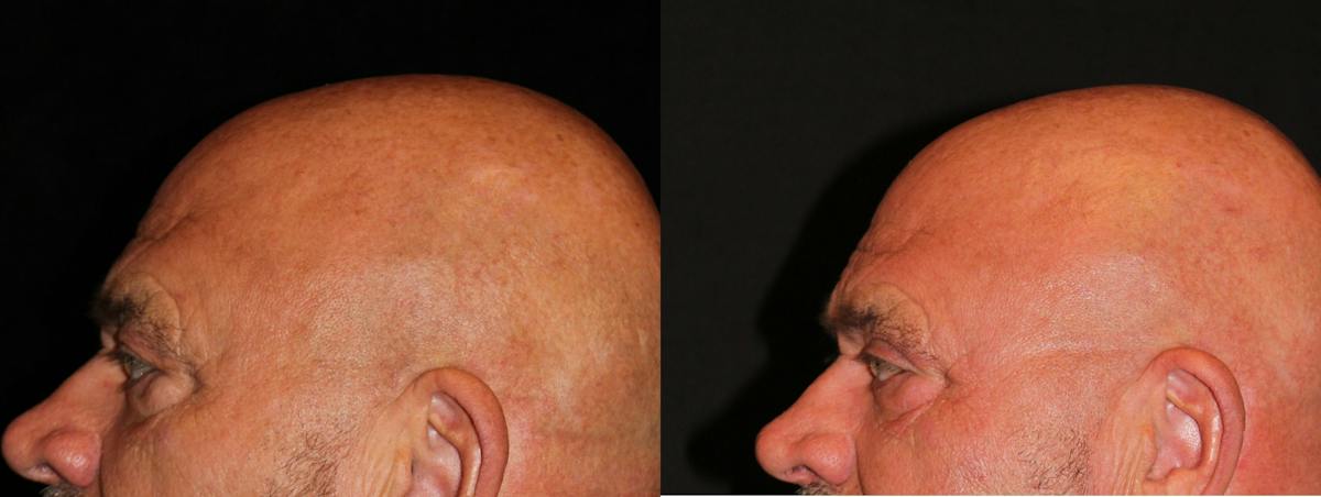 Eyelid Surgery Before & After Gallery - Patient 341994 - Image 3
