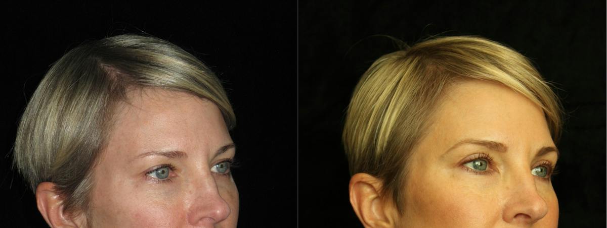 Eyelid Surgery Before & After Gallery - Patient 202153 - Image 2