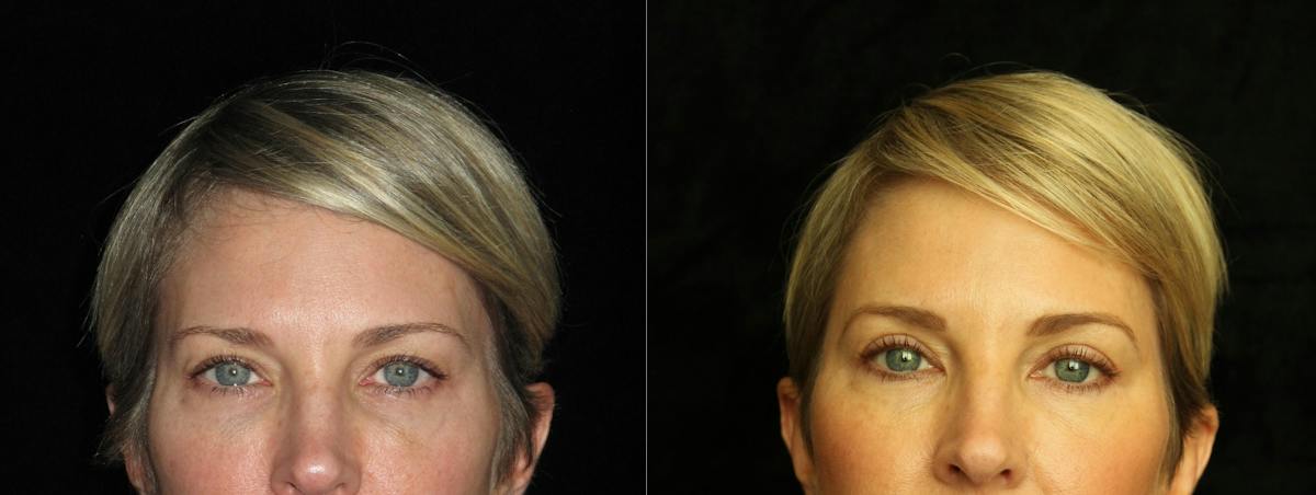 Eyelid Surgery Before & After Gallery - Patient 202153 - Image 1