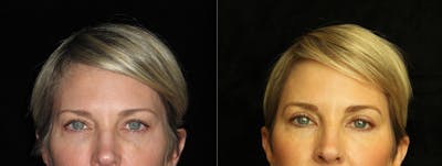 Eyelid Surgery Before & After Gallery - Patient 202153 - Image 1