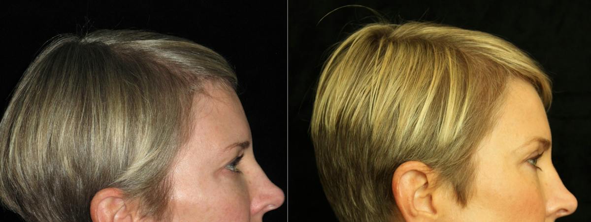 Eyelid Surgery Before & After Gallery - Patient 202153 - Image 3