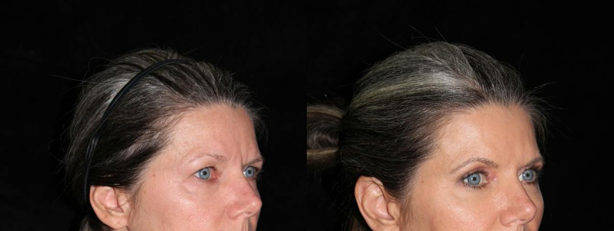 Eyelid Surgery Before & After Gallery - Patient 966344 - Image 2