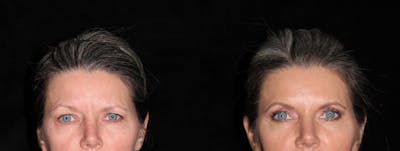 Eyelid Surgery Before & After Gallery - Patient 966344 - Image 1
