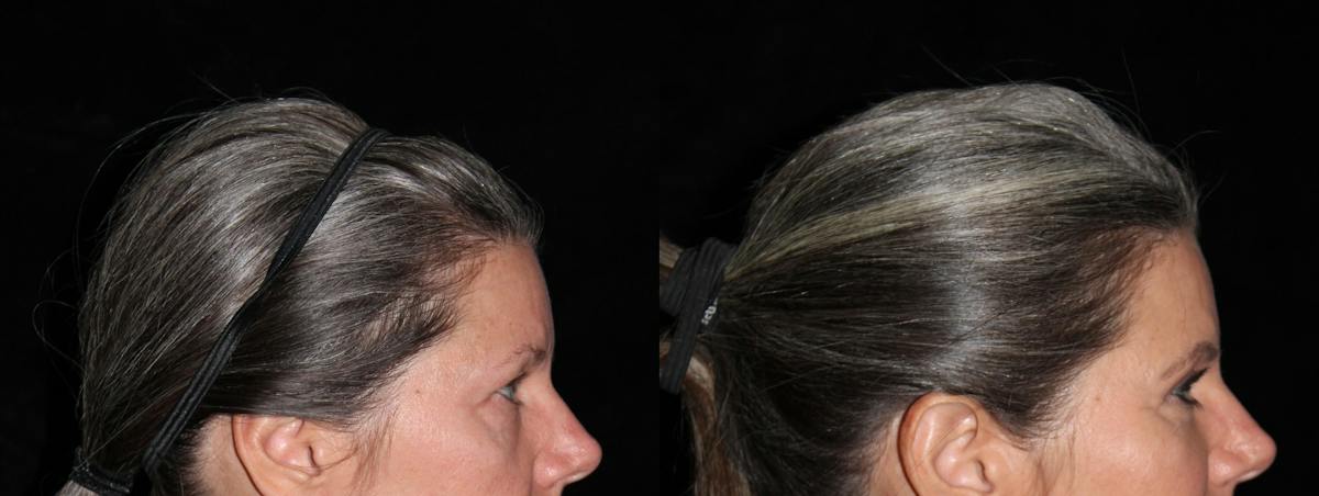 Eyelid Surgery Before & After Gallery - Patient 966344 - Image 3