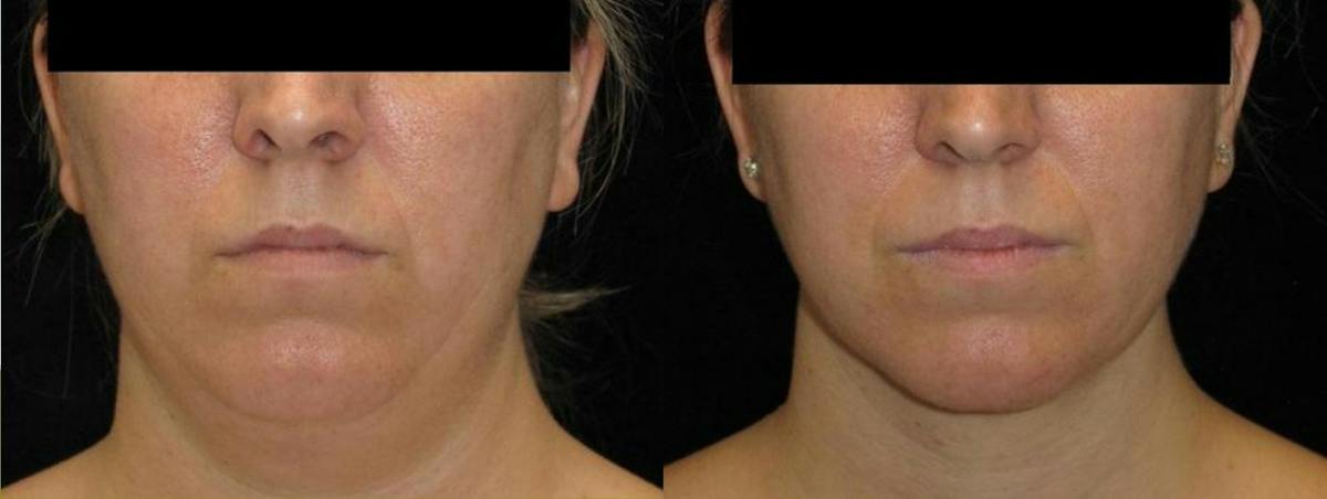 Facial Liposuction Before & After Gallery - Patient 702799 - Image 1