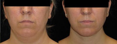 Facial Liposuction Before & After Gallery - Patient 702799 - Image 1