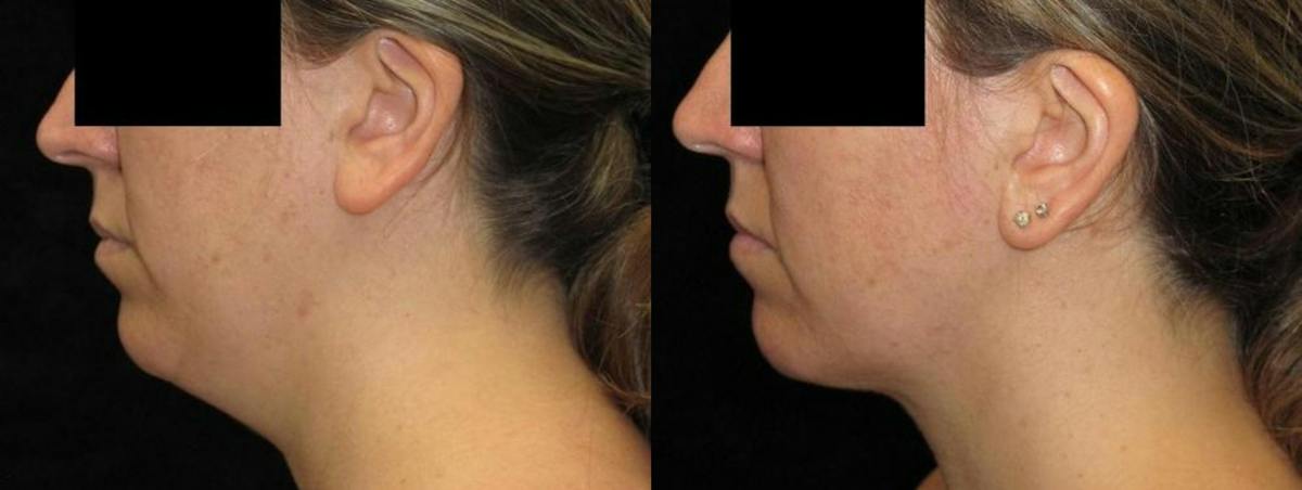Facial Liposuction Before & After Gallery - Patient 702799 - Image 2