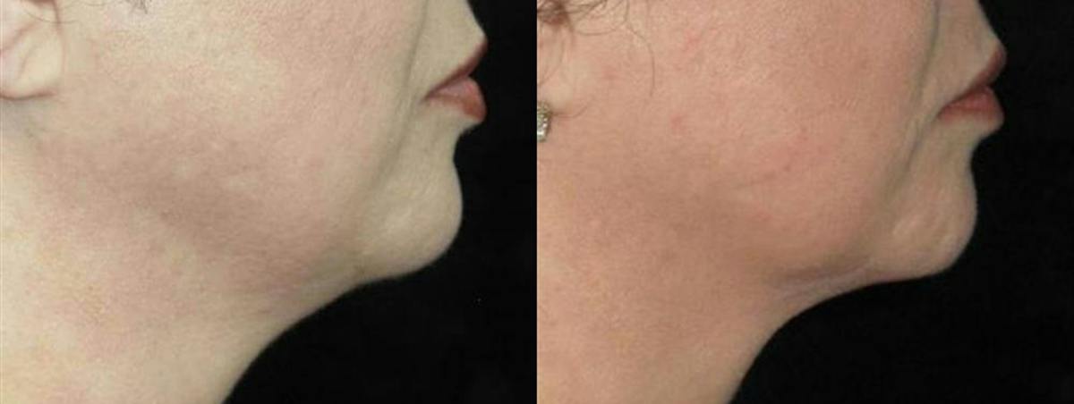 Facial Liposuction Before & After Gallery - Patient 343898 - Image 2