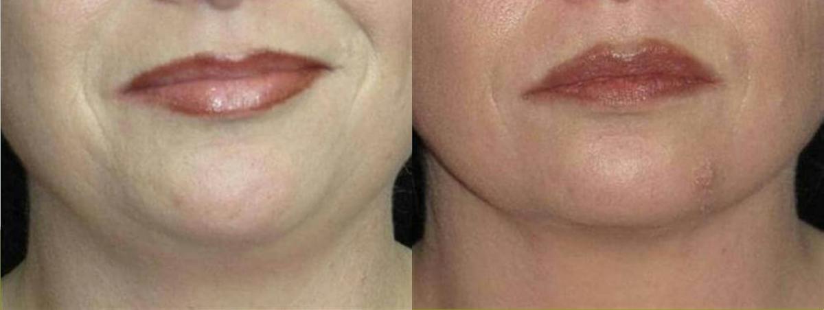 Facial Liposuction Before & After Gallery - Patient 343898 - Image 1