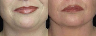 Facial Liposuction Before & After Gallery - Patient 343898 - Image 1