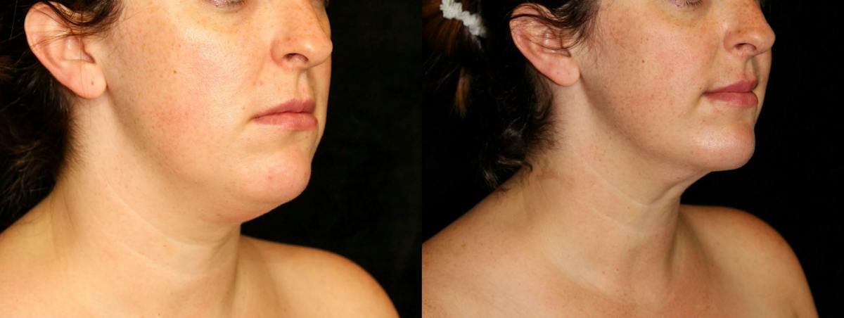 Facial Liposuction Before & After Gallery - Patient 292712 - Image 2