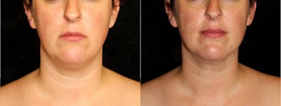 Facial Liposuction Before & After Gallery - Patient 292712 - Image 1