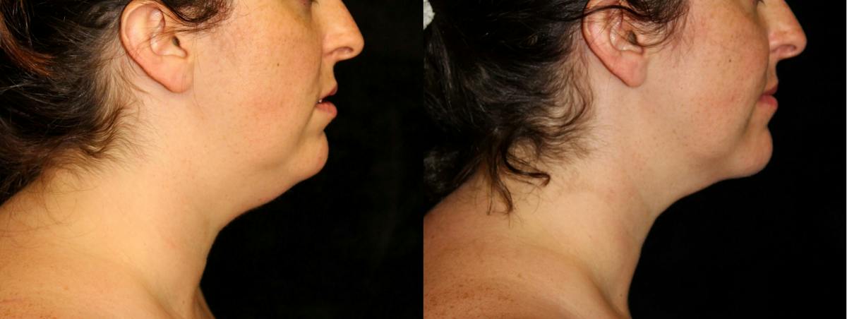 Facial Liposuction Before & After Gallery - Patient 292712 - Image 3
