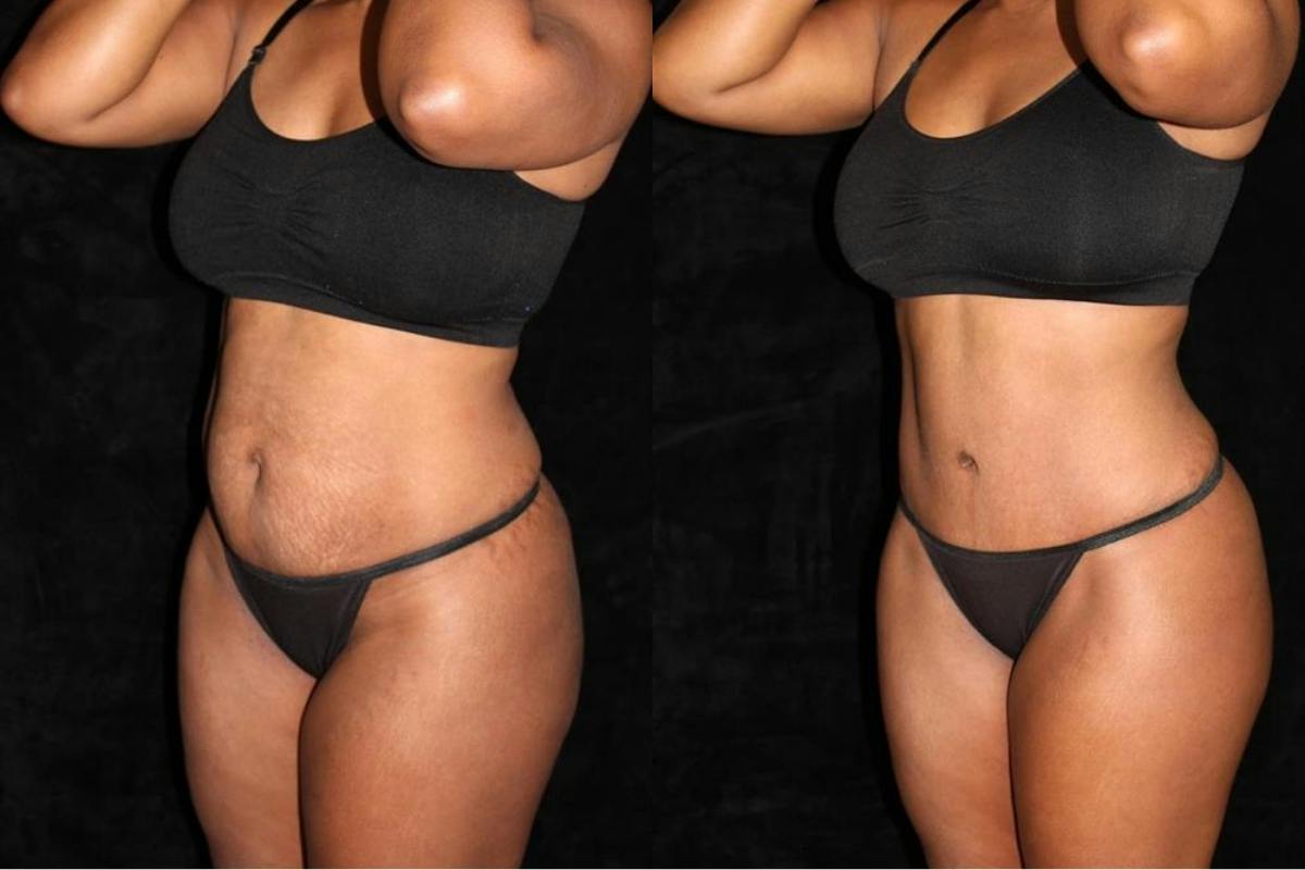 Liposuction Before & After Gallery - Patient 211442 - Image 2