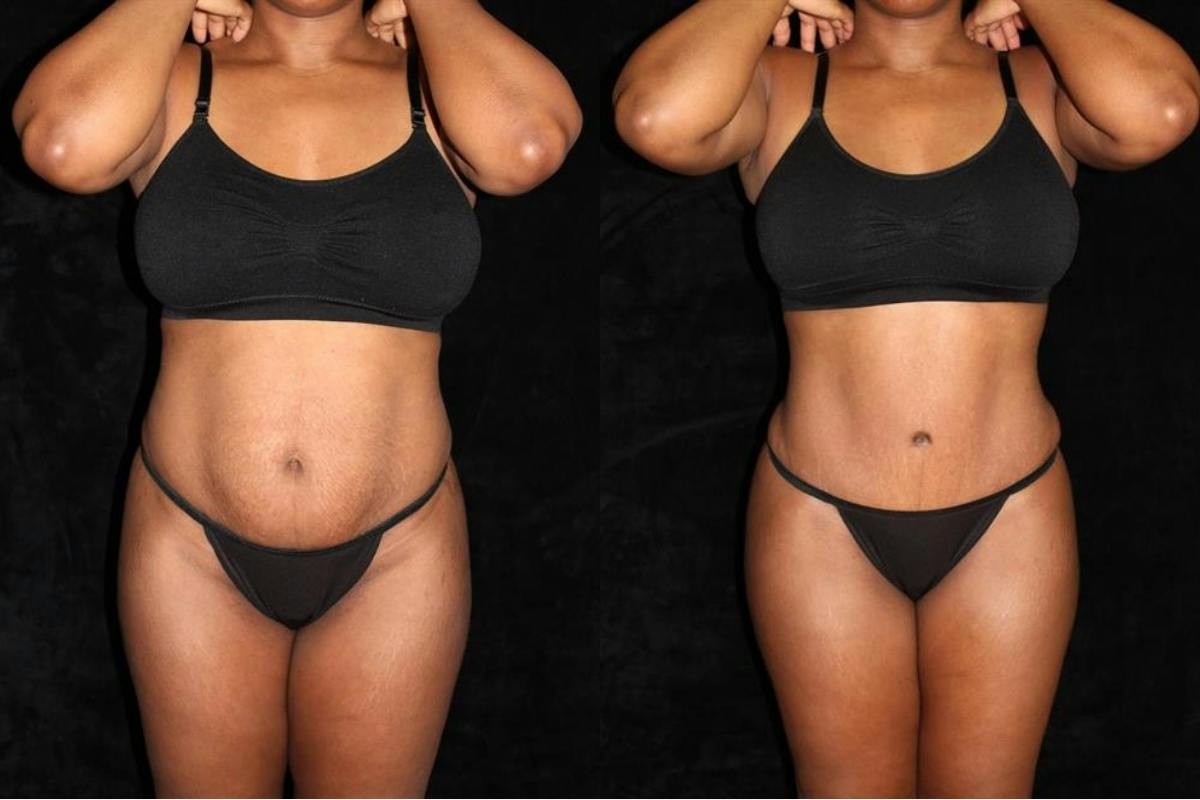 Liposuction Before & After Gallery - Patient 211442 - Image 1