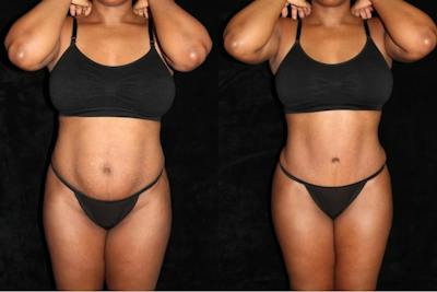 Liposuction Before & After Gallery - Patient 211442 - Image 1