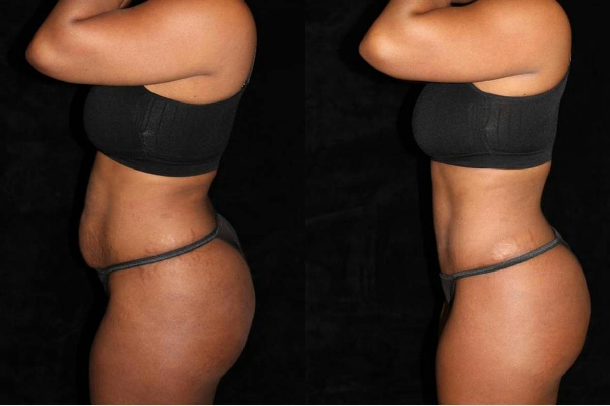 Liposuction Before & After Gallery - Patient 211442 - Image 3
