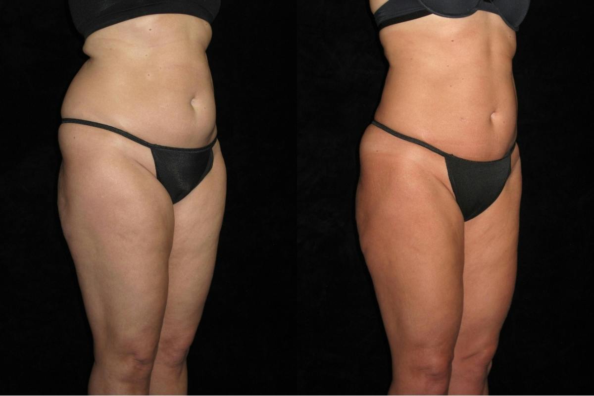 Liposuction Before & After Gallery - Patient 276450 - Image 2