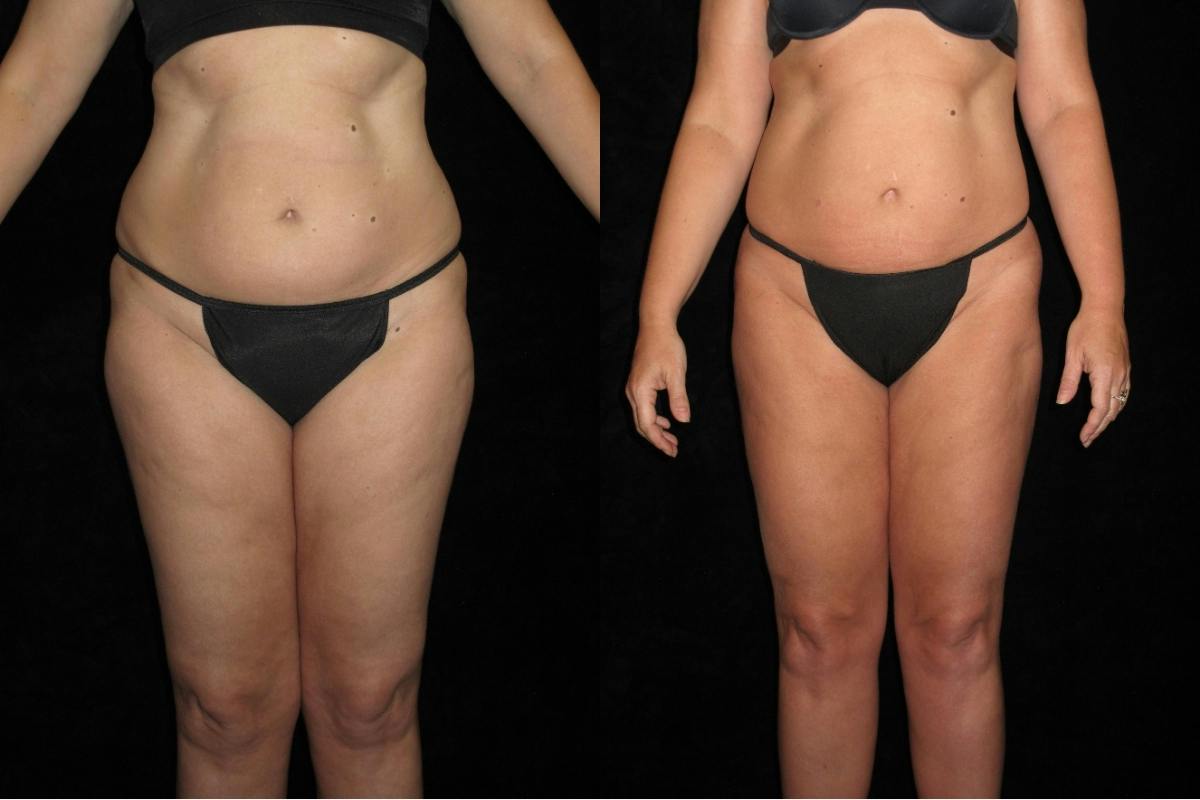 Liposuction Before & After Gallery - Patient 276450 - Image 1
