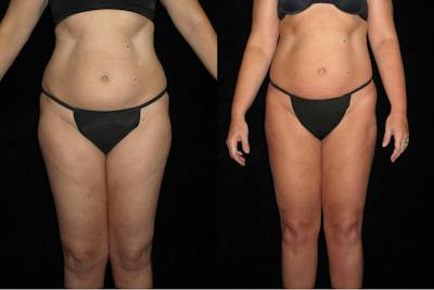 Liposuction Before & After Gallery - Patient 276450 - Image 1