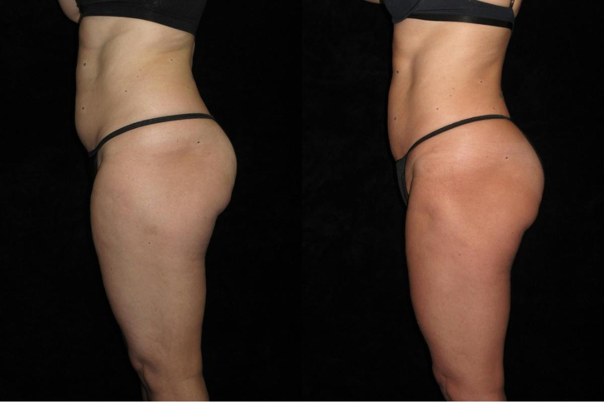 Liposuction Before & After Gallery - Patient 276450 - Image 3