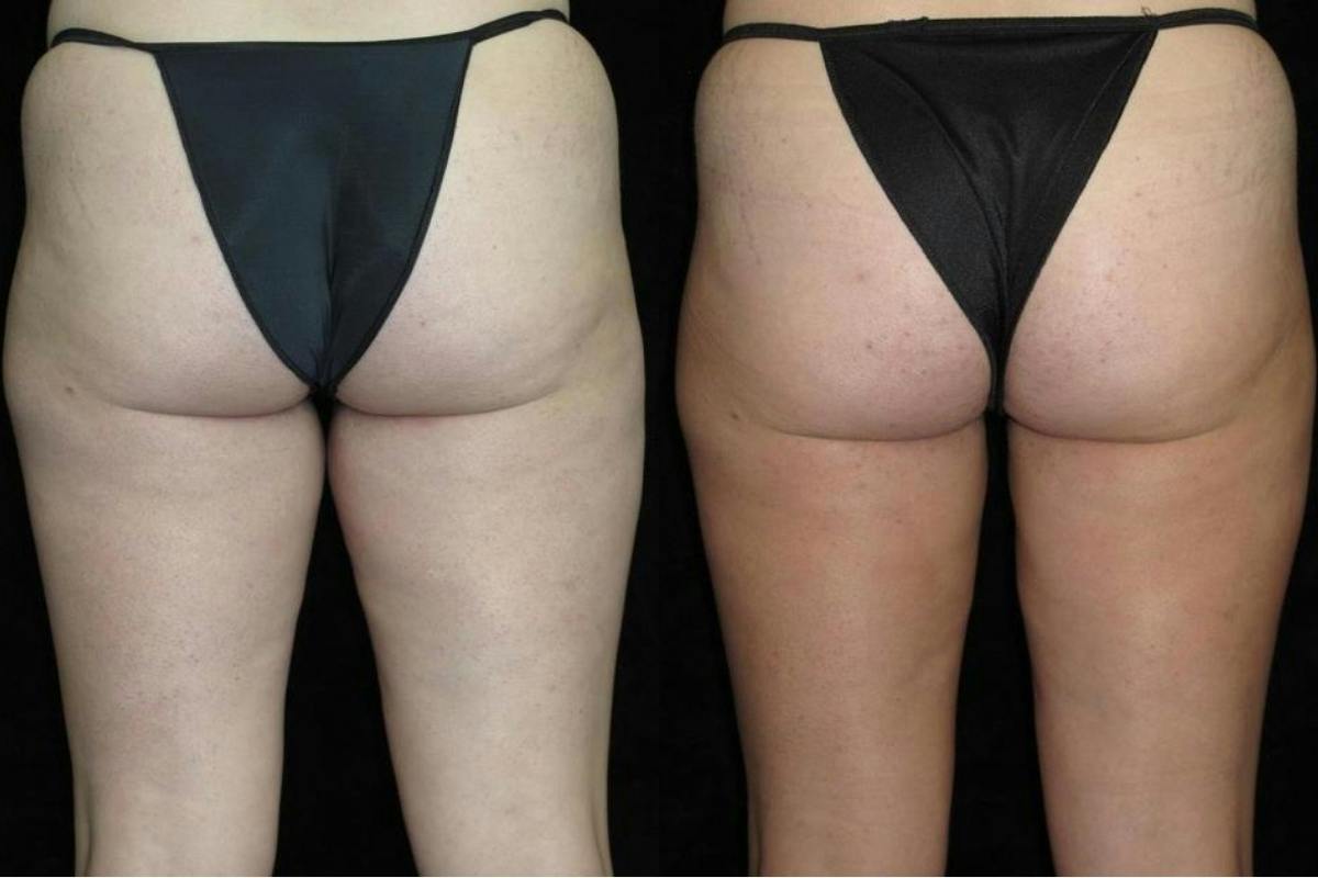 Liposuction Before & After Gallery - Patient 144966 - Image 2