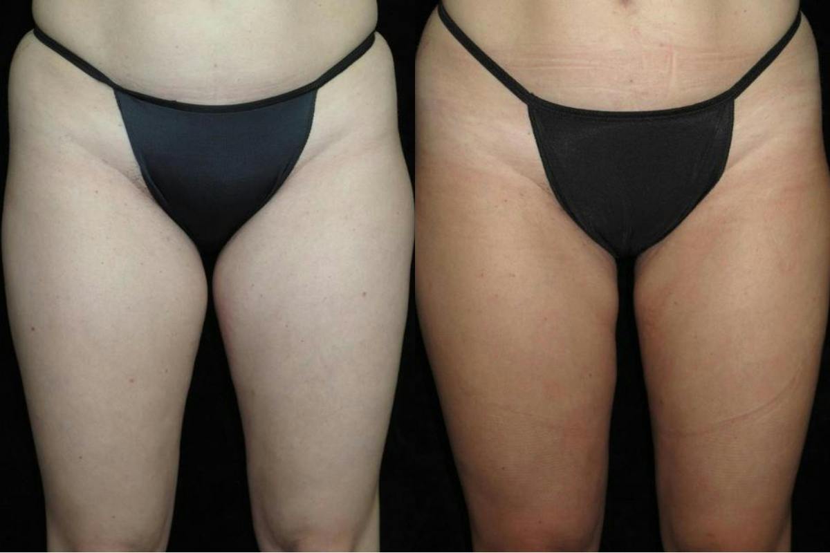 Liposuction Before & After Gallery - Patient 144966 - Image 1