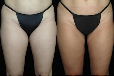Liposuction Before & After Gallery - Patient 144966 - Image 1